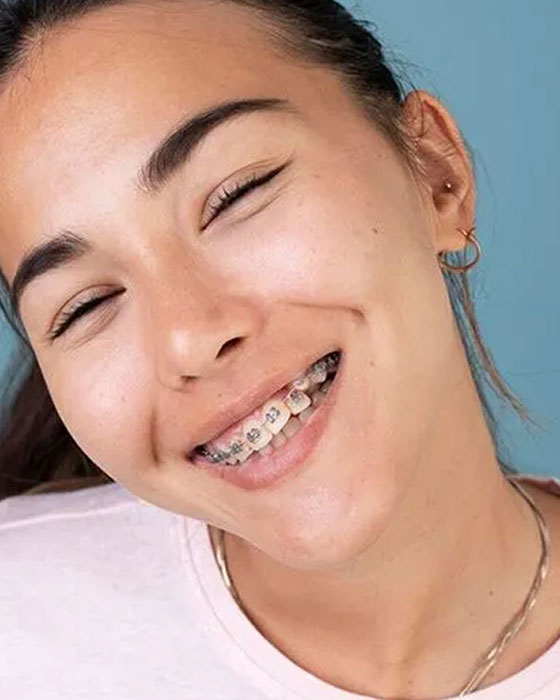 img-Traditional Metal Braces 