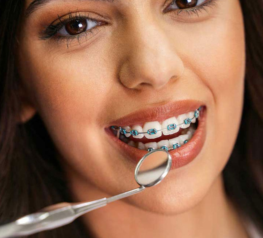 img-newsmile-treatment-benifits-braces-2