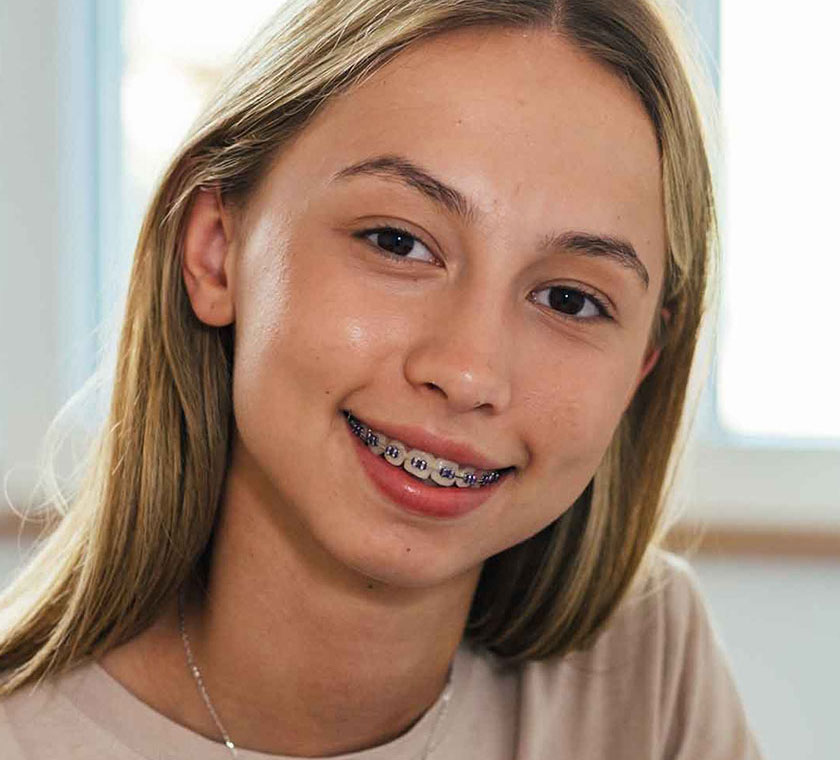 img-newsmile-treatment-benifits-braces-adults